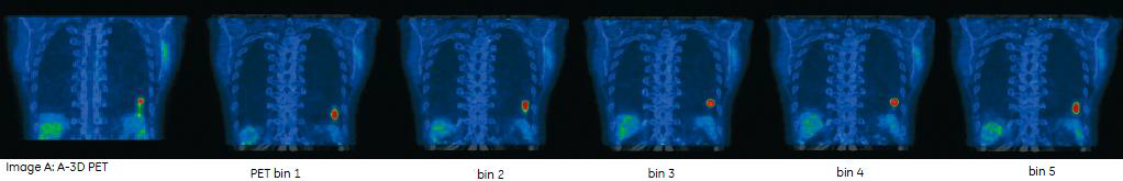 Respiratory gated PET