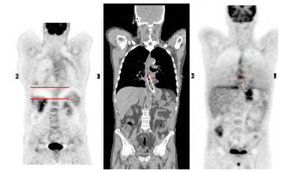 Target position moving due to respiratory in PET CT