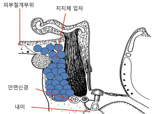 중이염 수술후 결손부위에 대한 유양돌기 폐쇄술