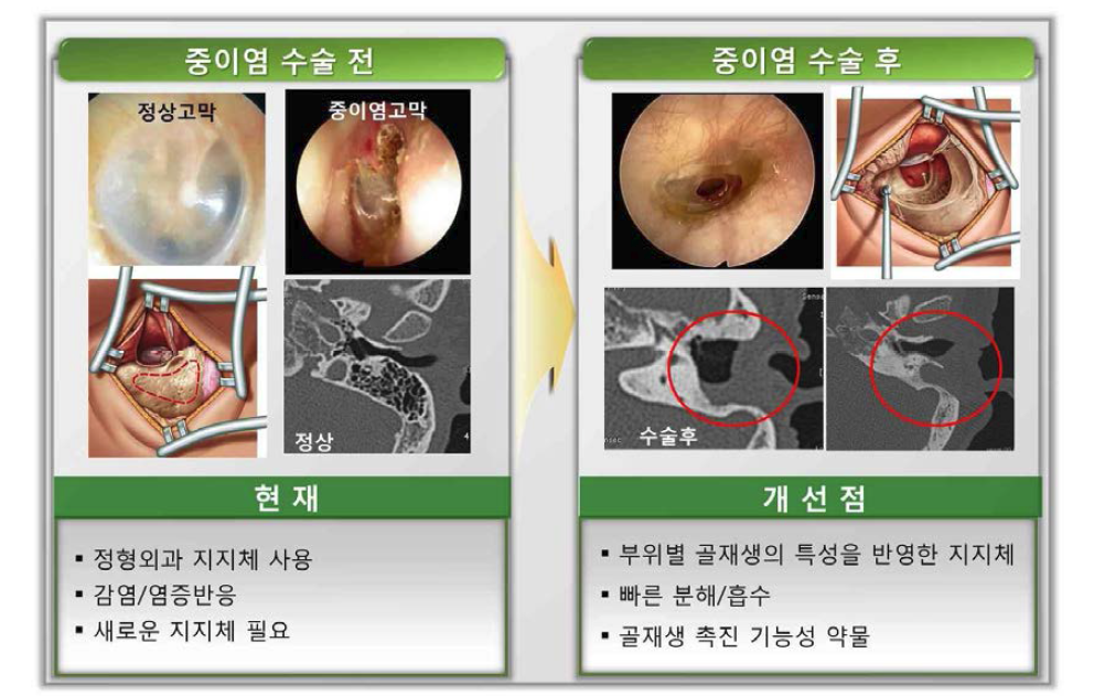 중이염 수술후 골결손에 대한 새로운 부위별 지지체의 필요성