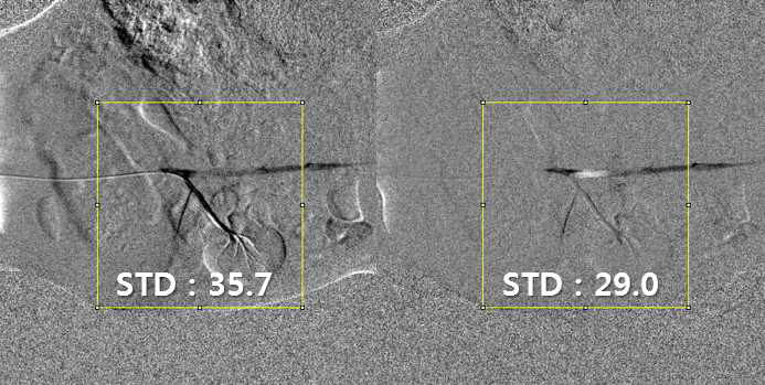 토끼의 신장 영역의 일반 DSA 기술과 움직임 추적 기반 DSA 기술의 결과 영상