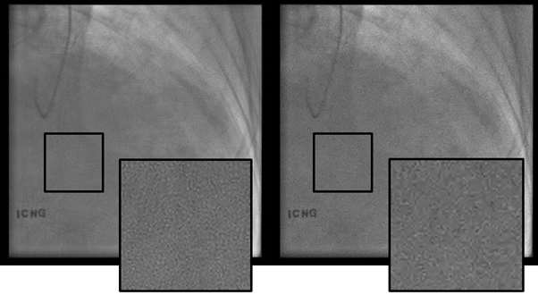 커블렛을 이용한 잡음 저감(좌) 영상과 웨이블렛을 이용한 잡음저감(우) 영상의 artifact 비교