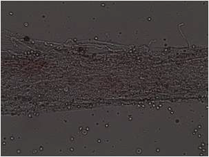 비교적 굵게 형성된 Fibrine의 도말표본 - 미세한 섬유가 얽혀있어 소 관다발구조와 유사한모습을 보인다.