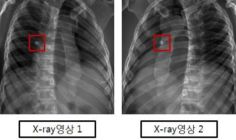 병변이 존재하는 stereo X-ray 영상 [NCAT 영상]