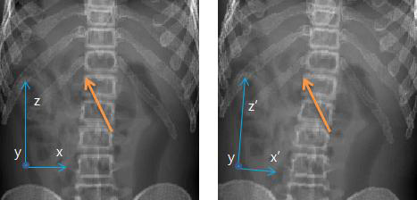 기존 CT영상을 이용한 X-ray 영상(좌), 방사선 치료 과정에서 얻은 환자 CT 영상(우)