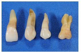 치아의 종류 (왼쪽부터 앞니, 송곳니, 작은어금니, 큰어금니)