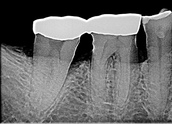 치근단 방사선사진의 예