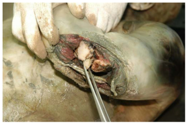 어구에 의한 손상(왼쪽 상완골의 골절 및 열창)