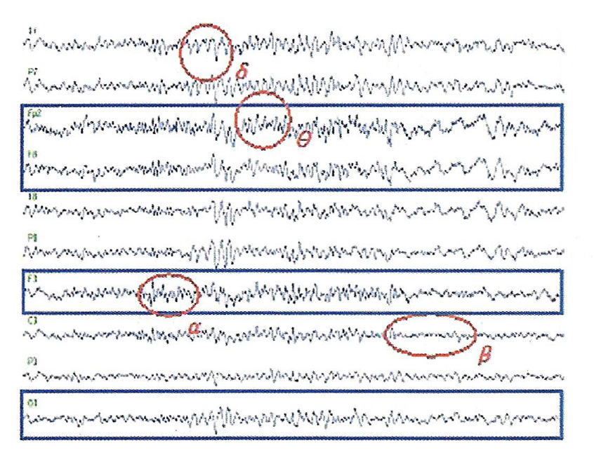 각성시 성인뇌파 예시