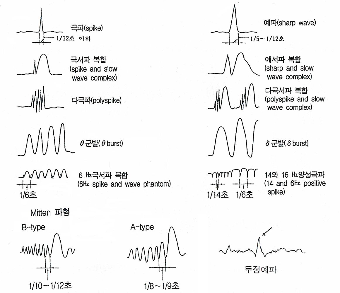 이상파형 예시