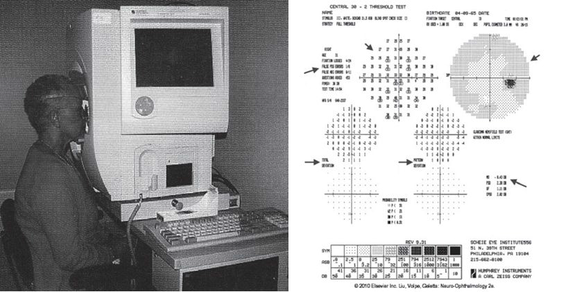 험프리 정적 시야계(HumphreyStaticPerimetry)및 우안의 정적시야 범위