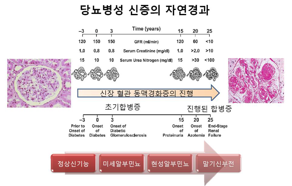 당뇨병성 신증의 자연 임상 경과