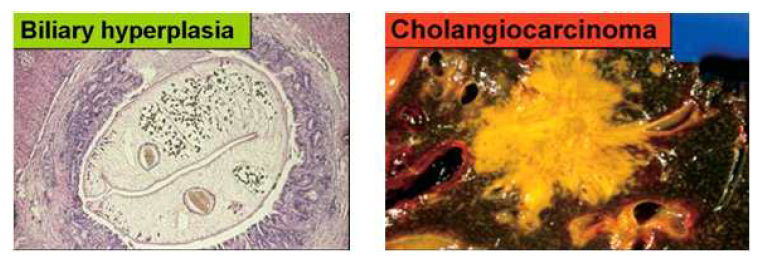 C. sinensis infection caused intrahepatic epithelia hyperlasia, fibrosis, and cholangiocarcinoma.