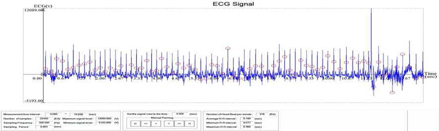 피실험자의 ECG Data를 Visual Studio를 통해 실행된 ECG Signal 프로그램으로 분석했을 시 나온 환자의 ECG signal과 검출된 R-Peak