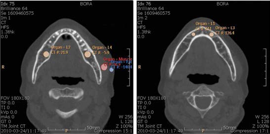 골다공증 환자의 악골 Q-CT 소견. 좌측, 환자 악골에 대한 bone density를 측정하기 위해 좌측과 같이 환자 자신이 가지고 있는 지방과 근육을 기준으로 해서 VOI (volume of interest) 영역의 bone density를 어금니에 대해 측정함. 우측, 송곳니에 대해 bone density를 측정함.