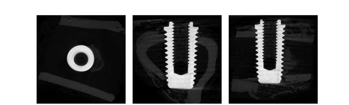 TCP bead + BMP-2 이식 4주 micro-CT 소견