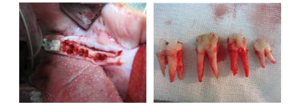 하악골 발치 후 모습(좌), 하악골에서 발치 된 치아(우)