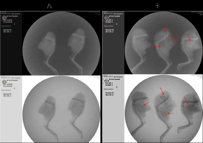 동물실험의 x-ray 결과. [A: β-TCP 마이크로스피어와 히알루론산 파우더겔 복합체, B: β-TCP 마이크로스피어와 히알루론산 파우더겔 복합체 + BMP-2 (50ug/defect)) red arrow: 골 형성 부분.