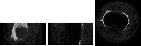 rhBMP-2 + VEGF 이식 2주 micro-CT. 좌측은 관상면, 중간은 시상면, 우측은 액와면 소견