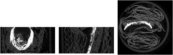 rhBMP-2 이식 6주 micro-CT. 좌측은 관상면, 중간은 시상면, 우측은 액와면 소견