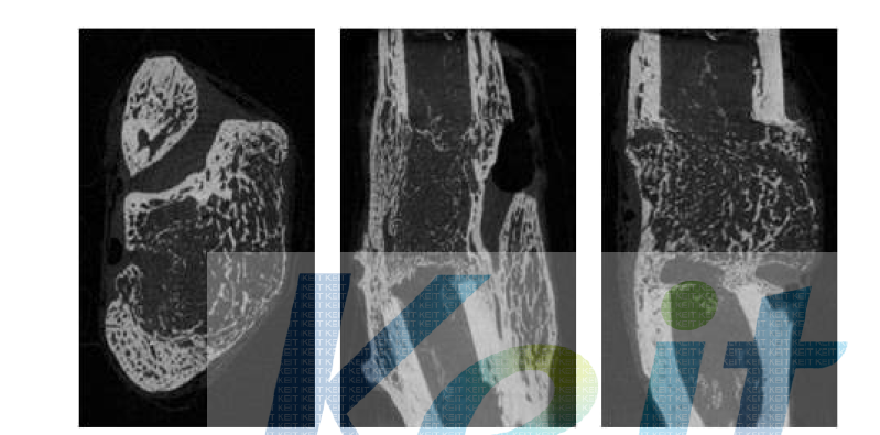 제 2군 collagen + BMP-2 8주 micro-CT 사진