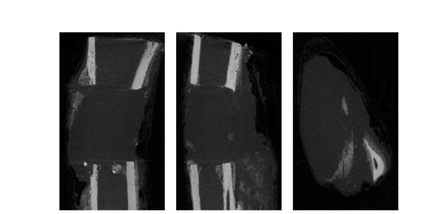 제 3군 collagen + BMP-2 + EGF 2주 micro-CT 사진