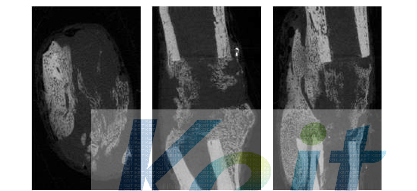 제 3군 collagen + BMP-2 + EGF 4주 micro-CT 사진