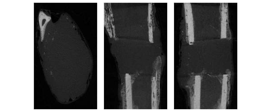 제 4군 collagen + BMP-2 + FGF 2주 micro-CT 사진