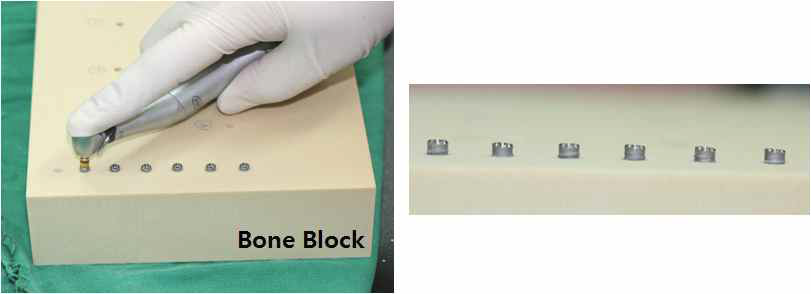Bone block을 이용한 임플란트 고정체 식립 과정