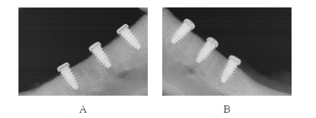 각각 3개씩 식립 x-ray 사진. A: 죄측 하악골, B:우측 하악골 식립 후 x-ray 사진