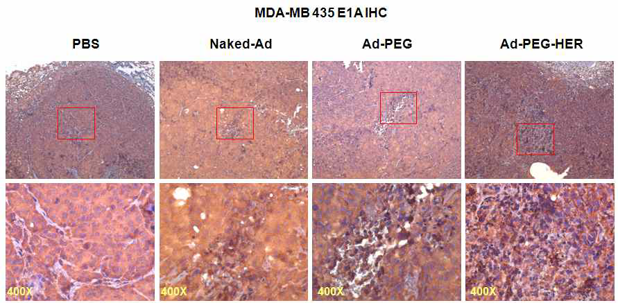 PEG-HER 로 중합된 종양 선택적 살상 아데노바이러스 제제의 투여 후 종양 내 조직 변화 관찰
