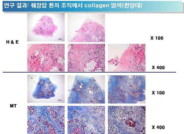 췌장암 환자 조직에서 collagen 염색 결과