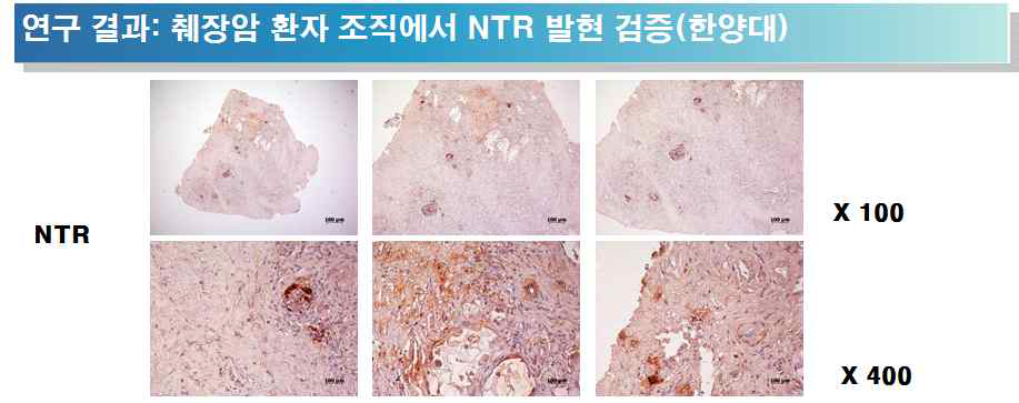 췌장암 환자 조직에서 NTR 염색 결과