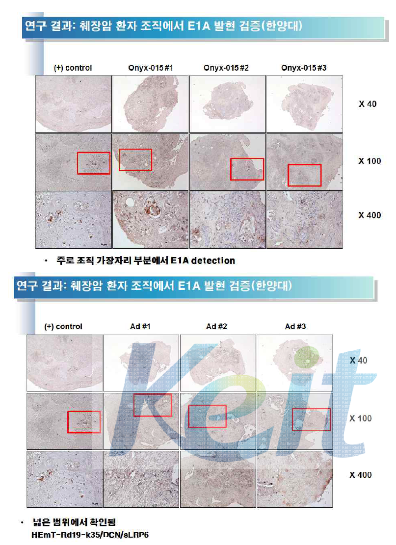 췌장암 환자 조직에서 Ad E1A 염색 결과