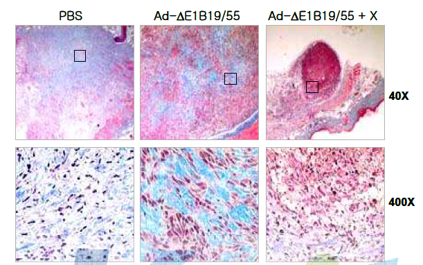 종양 선택적 살상 아데노바이러스와 protein-X 단백질을 함께 투여한 경우의 종양내 세포외기질의 변화 관찰