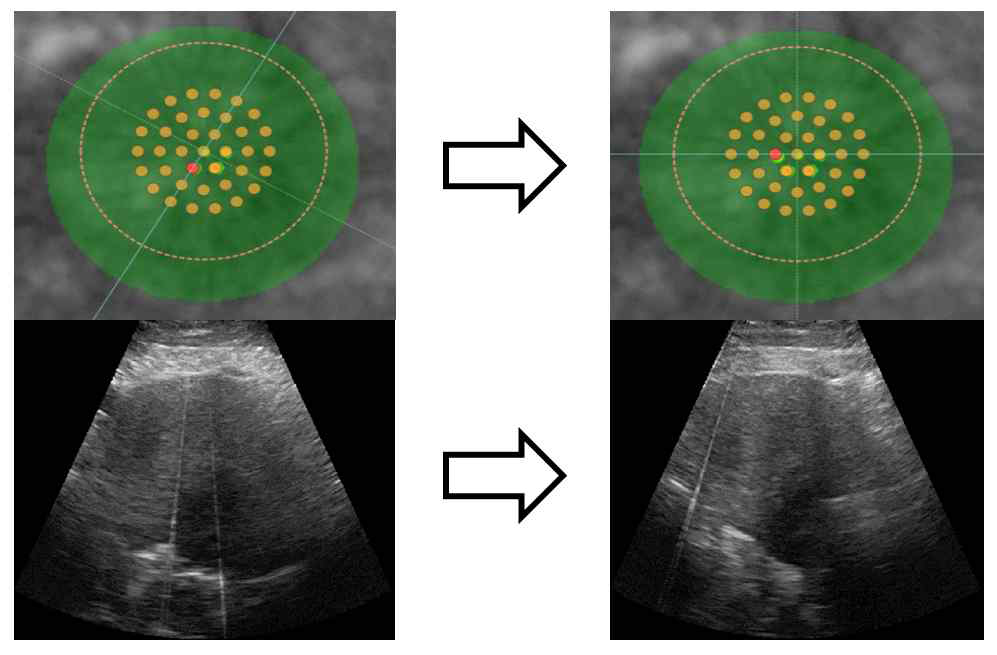 HIFU 치료 Target이 달라질 경우 Transducer의 각도가 변하게 되어 Image probe에서 얻는 초음파 영상이 달라짐을 나타내는 그림.