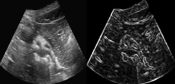 왼쪽은 초음파 영상의 Intensity, 오른쪽은 Edge 정보를 나타낸 모습