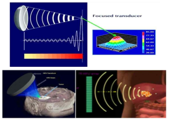 고강도 집속 초음파를 이용한 암 치료