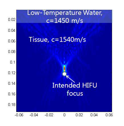 굴절로 인한 HIFU 초점의 이동