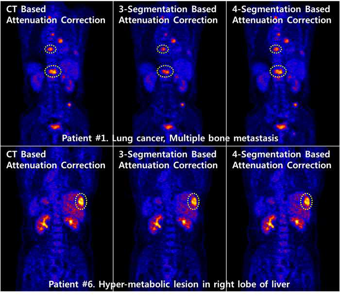 척추 및 간암 환자에 대한 감쇠보정 비교 결과