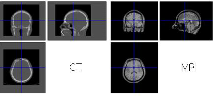 CT와 MRI의 정합 후 비교 영상