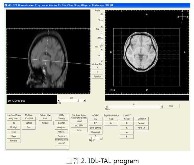 MR 영상의 공간 정규화를 위한 IDL-TAL 프로그램