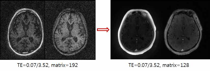 Matrix 사이즈에 따른 MR 영상 결과 비교