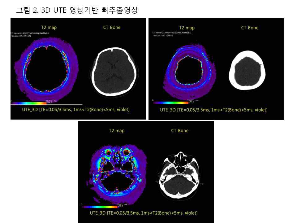 3D UTE 영상기반 뼈추출 영상