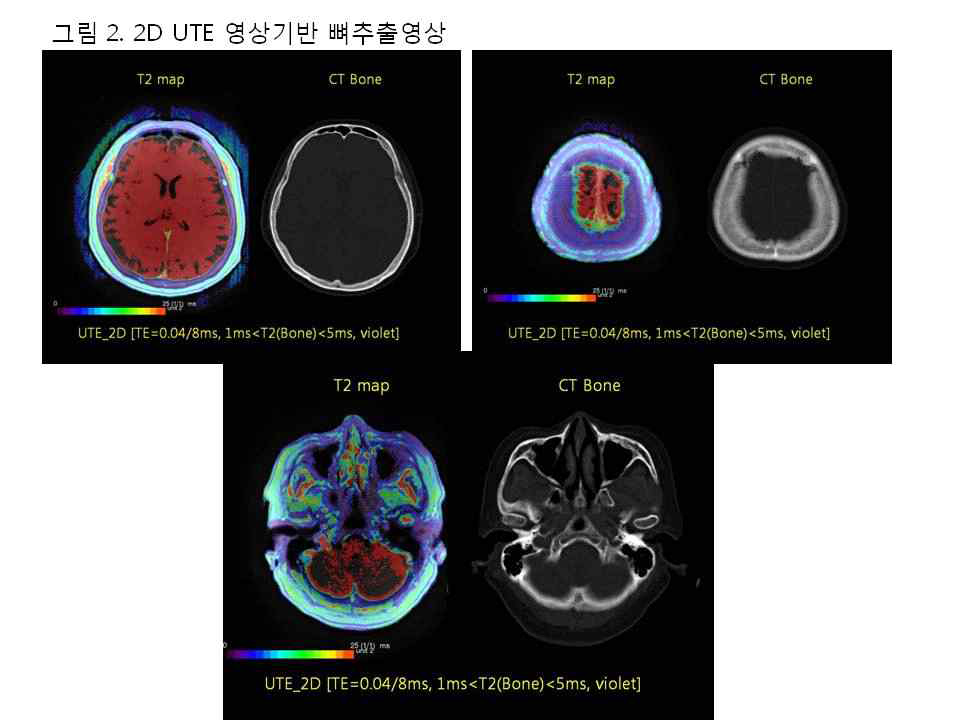 2D UTE 영상기반 뼈추출 영상