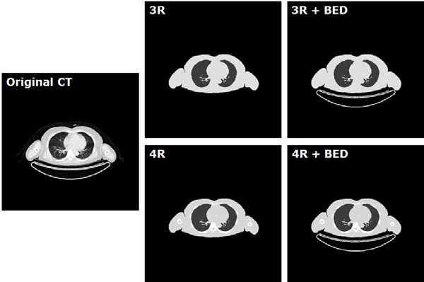 CT영상과 이를 3영역, 3영역+베드, 4영역, 4영역+베드로 분할한 영상