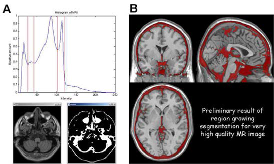 MRI 영역분할을 통한 PET 감쇠 보정을 위한 MR 영역분할 기법에 대한 기 초 연구