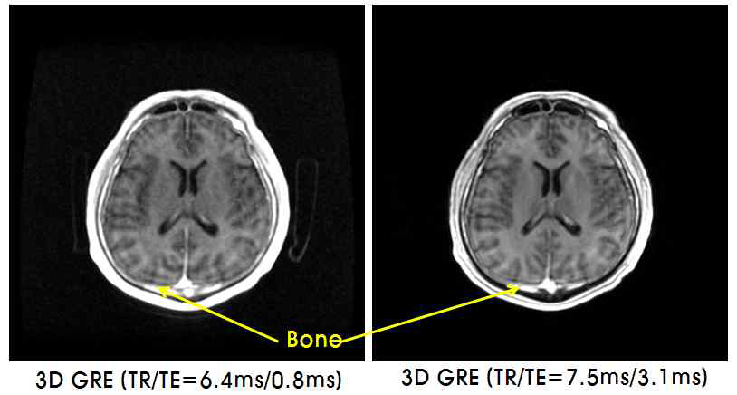 뇌의 short TE 영상