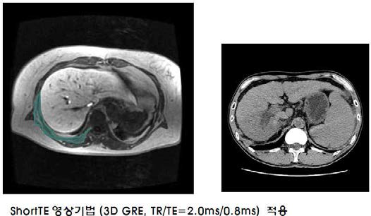 복부의 short TE 영상과 CT 영상. Rib(bone)과 muscle (반투명영역) 영역 구별 안됨