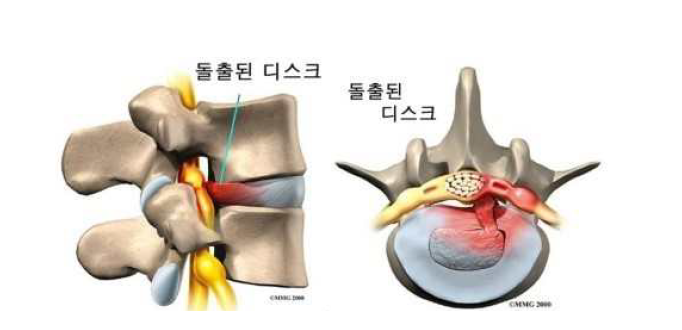 돌출된 디스크.